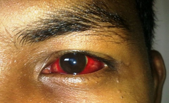 The Dengue Eye