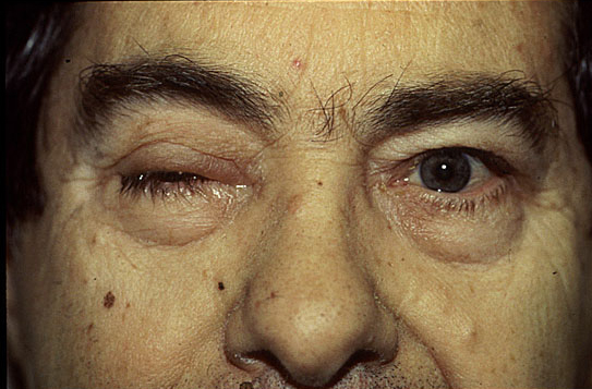 iiipalsyptosis